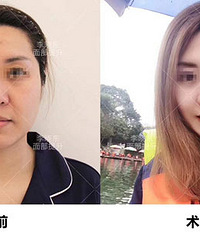 �����������沿����ȥ������Ч����ô��