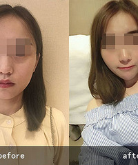 李晓东面部提升费用需要多少