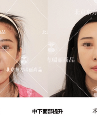 北京面部提升李晓东案例