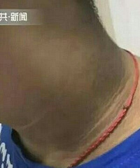 脖子发黑总洗不干净,竟然是病!医生:不控制后果很严重…