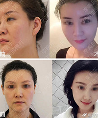 李晓东PST面部提升一个部位多少钱?