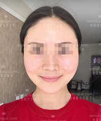 李晓东PST面部提升 —— 挽救松弛下垂的面部!