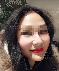 李晓东PST面部提升 —— 挽救松弛下垂的面部!