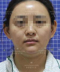 李晓东PST面部提升是如何改善脸下垂的?