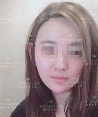 李晓东PST面部提升是如何改善脸下垂的?