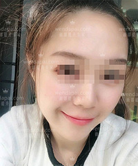 北京面部皮肤松弛怎么办?李晓东PST埋线提升来改善!