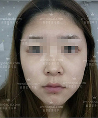 北京李晓东PST面部提升,面部提升解决皮肤松弛