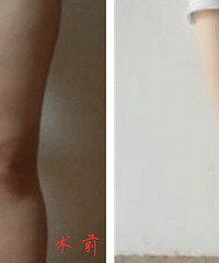 成都吸脂减肥效果怎么样?整形刘晶介绍吸脂手术的特点