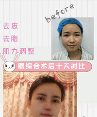 成都双眼皮,双眼皮那么多, 为什么非得选择韩式精雕双眼皮?