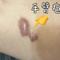 【成都割双眼皮】刘晶整形医生,关于双眼皮手术,你了解有好多