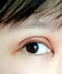 成都双眼皮医生刘晶,双眼皮最全攻略都在这!