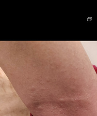 我妈手臂上发了很多水泡,是什么?现在很痒