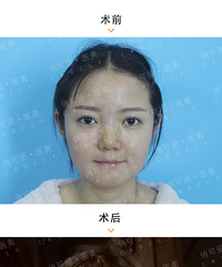 成都隆鼻哪家好? 贾德渊鼻子价位