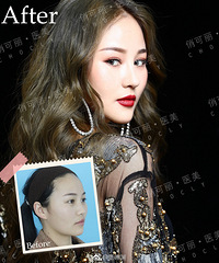 成都隆鼻专家贾德渊讲解全肋与半肋的区别?