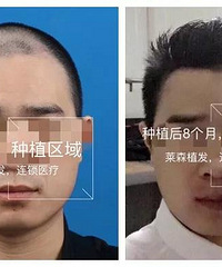 怎么判断植发是失败了-莱森植发医院
