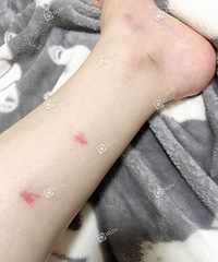 去西湖转了圈被咬了30多个包£¡什么虫子这么厉害£¿