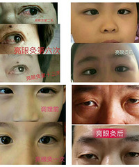 德仁艾亮眼灸
