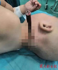 吓人!一岁男孩头插铅笔被送进医院,差点没命!