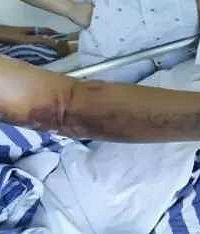 21岁大学生掰手腕,“吧嗒”一声悲剧了!医生:从业20年第一次见