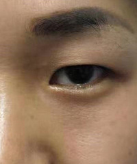 贵阳做双眼皮医院,做完双眼皮术后该如何护理?