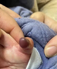 杭州5个月大宝宝因为一根橡皮筋,差点要截肢!