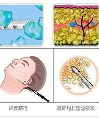 贵阳面部吸脂手术攻略,和脸上脂肪说拜拜