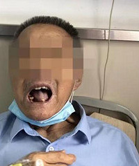 87歲大爺自己用鋼絲鉗拔牙后住進ICU