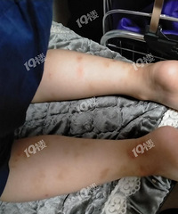 孩子腿腳上全是小紅點,會是狗狗身上的跳蚤咬的嗎