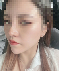 兩萬五做鼻子,現在我呼吸困難不能自理