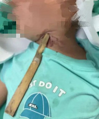 凌晨紧急抢救!2岁宝宝被木棍插喉,差点没命