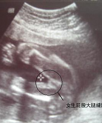 "教大家怎么看B超上的男女性别"