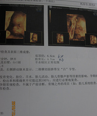 "今天去做了市一三围B超,结果是单脐动脉"
