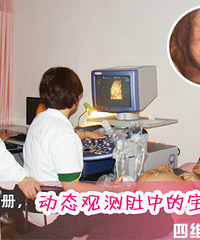 "四维彩超注意事项是什么"