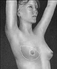 "从腹部搬来脂肪重塑新乳房"
