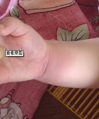 "妈妈要注意蚊虫叮咬。。宝宝手肿的像小馒头(图)"