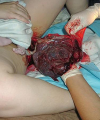 16��Ů�����϶�̥ ��ϧ�������  ̥�̶���������