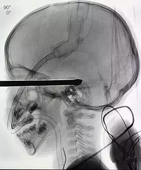 �����к�ˤ�´�����˿��������Բ���Σ�أ�ԭ����