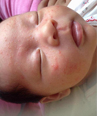 �����ƣ�ҽ�����������ϳ�����ʪ�����ʲô��������