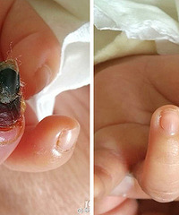 19���СӤ����ָȱѪ���� ������Ϊ��