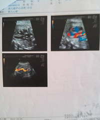 ����28�ܲ��̥���Ҽ��ȱ�� �����ж�Լ3mm...