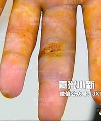 ����Ҫ��Ҫ�����ڣ����˶��˱���ҧ�˲���ָ ҽ��˵�˵������