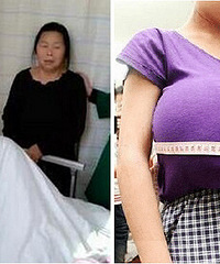 女童患上巨乳症 3.5小时切除4公斤巨乳