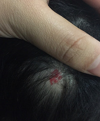 ͷƤ���Ѫ������