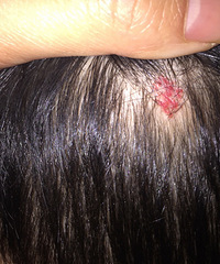 ͷƤ���Ѫ������