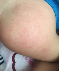 ����ƨ���϶��Ǻ�ɫ���  ���Ƽ�ҩ��