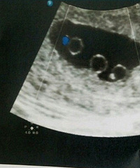 ���в��ͬ������̥ ���Լ�̥��