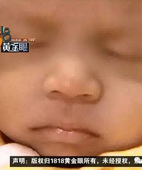 Ӥ����ɫ���� ������֢�໤�� ������ɩָ��ʧ��