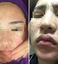 在嘉兴某美容院做面部护理 惨!