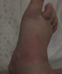 һ�����죬С���ӵĽžͱ�ҧ�Ĳ��ܿ��ˣ���ô�죿