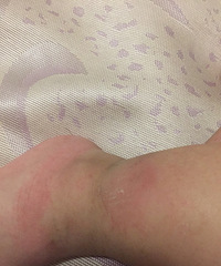 һ�����죬С���ӵĽžͱ�ҧ�Ĳ��ܿ��ˣ���ô�죿